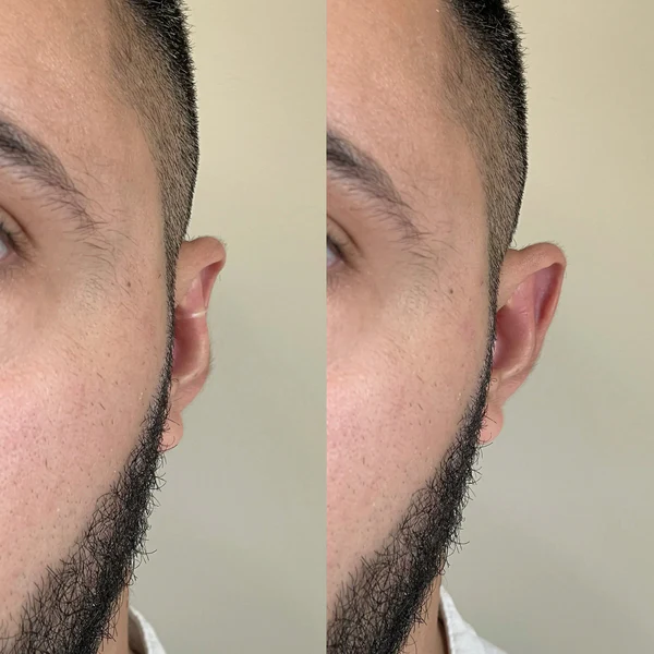 Aurix – Ear Corrector Clip